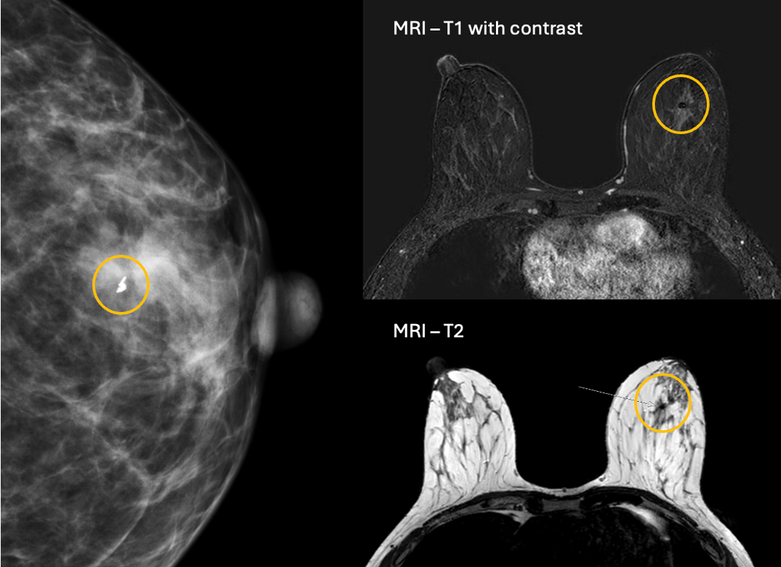 Image of Gold Anchor fiducial marker in breast
